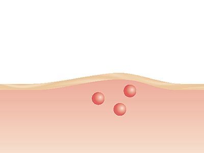 Efecto de un curador de picaduras de insectos Beurer