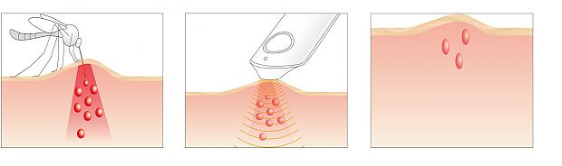 Insektenstichheiler Anwendung