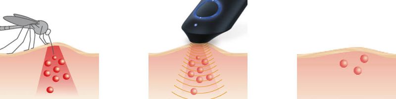 Darstellung der Funktionsweise eines Insektenstichheilers: Hitzeimpuls lindert Juckreiz und Schwellung an der betroffenen Hautstelle
