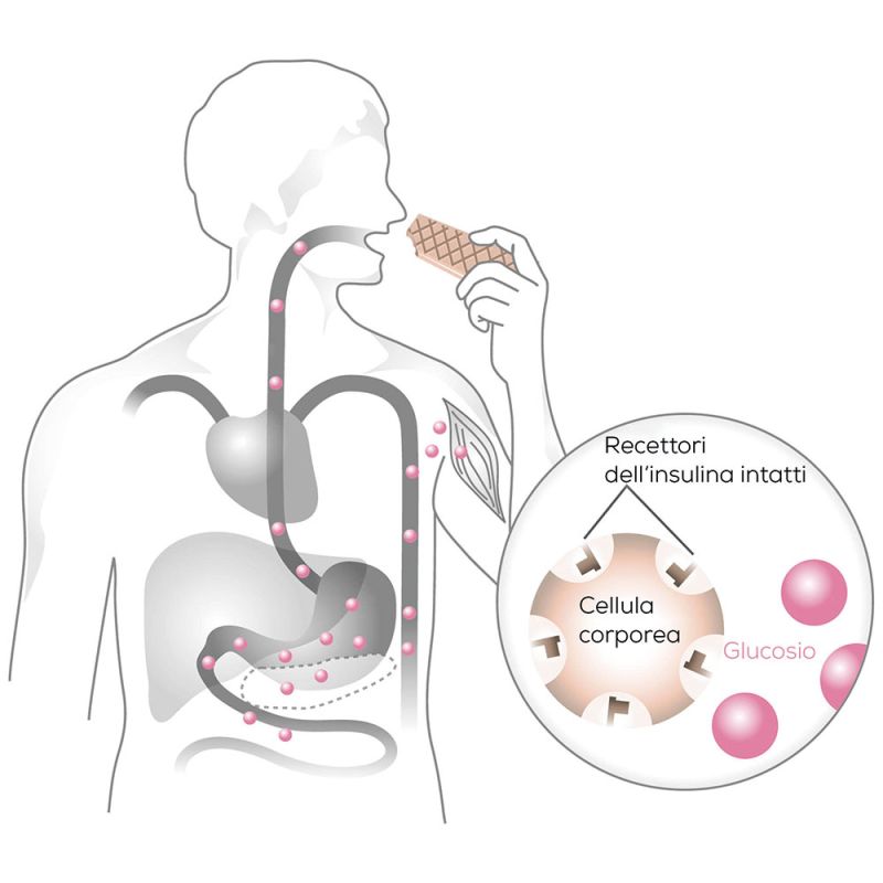 Illustrazione di Beurer del principio di chiusura della chiave del glucosio nel sangue nel diabete di tipo 1