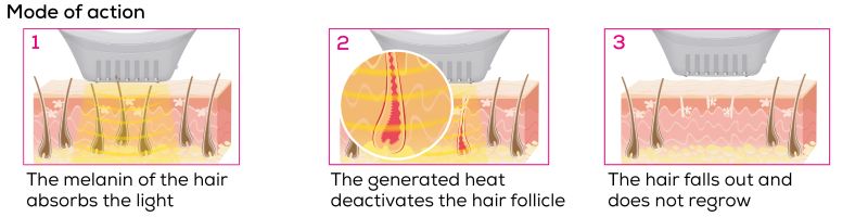 How an IPL device works in three steps: Melanin in the hair absorbs the light. Generated heat deactivates hair follicles. Hair falls out and does not grow back