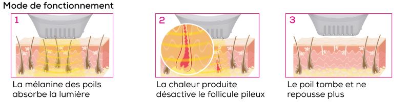 Mode de fonctionnement d'un appareil IPL en trois étapes : la mélanine dans le poil absorbe la lumière. La chaleur générée désactive le follicule pileux. Le poil tombe et ne repousse plus