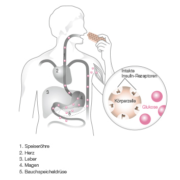 Beurer Erklärungsgrafik Diabetes Typ 1