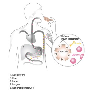 Beurer Erklärungsgrafik Diabetes Typ 2